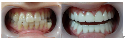 爱齿尔口腔瓷贴面案例