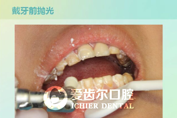爱齿尔口腔瓷贴面修复氟斑牙案例