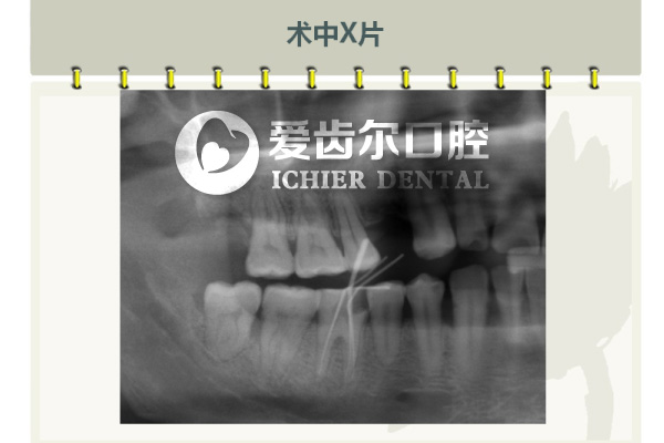 爱齿尔万碧涛主任根管治疗案例