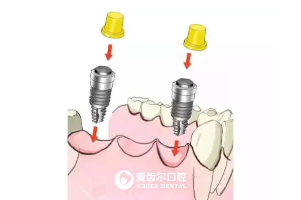 爱齿尔种植牙