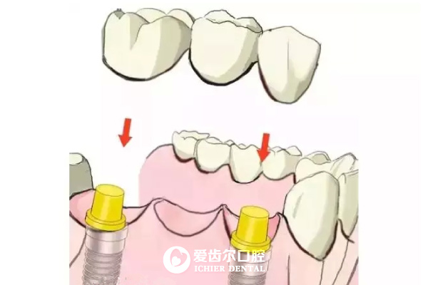 爱齿尔种植牙