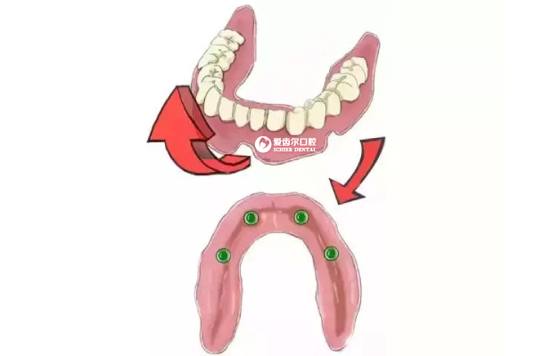爱齿尔种植牙