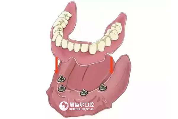 爱齿尔种植牙