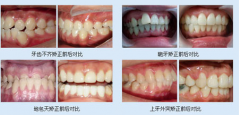 湖北牙齿矫正费用