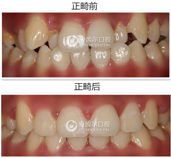 爱齿尔口腔案例对比图