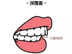 <b>牙齿深覆盖矫正过程图</b>