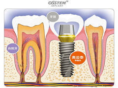 <b>奥齿泰种植牙价格多少</b>