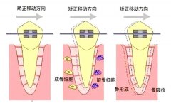 牙齿矫正有年龄限制吗