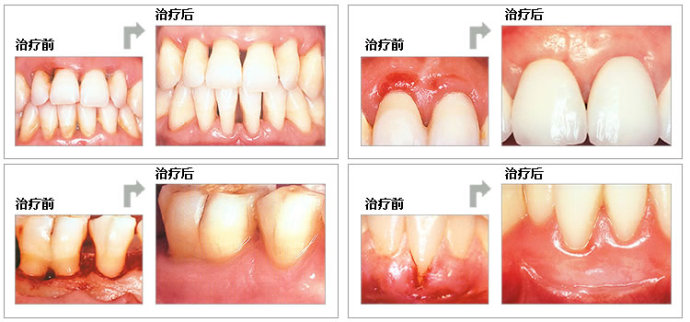武汉牙周病治疗