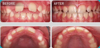 案例（乳牙恒牙混合期）矫正期6个月