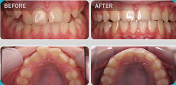 案例（乳牙恒牙混合期）矫正期10个月